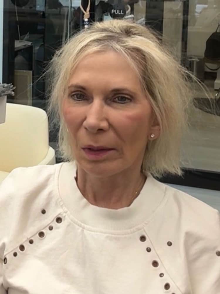 Before and after thinning hair coverage using hair topper in Delray Beach